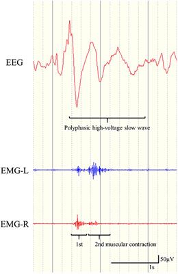 Insufficient Efficacy of Corpus Callosotomy for Epileptic Spasms With Biphasic Muscular Contractions